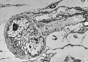 M,15y. | rhabdomyoma - lip